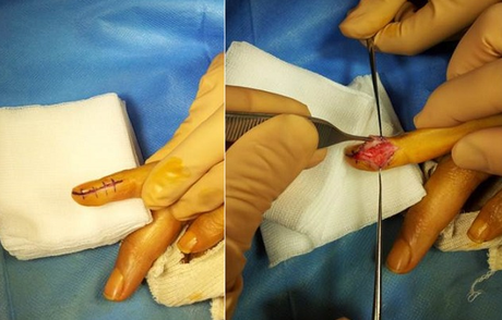 Tumeur glomique de la main : douleur insoutenable de l’ongle
