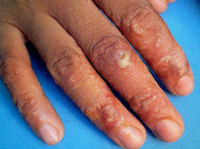 obat penyakit herpes di tangan obat herpes di tangan