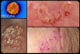 obat penyakit herpes di tangan Mengobati Herpes Dengan Cepat