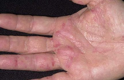 obat herpes pada tangan obat penyakit herpes di tangan