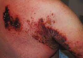 obat herpes tangan obat herpes di tangan