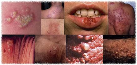 obat untuk herpes di tangan Obat Herpes Bawang Putih