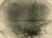 #thelancetpsychiatry #traumatismecrânien #démence Risque démence long terme parmi personnes ayant subi traumatisme crânien Danemark étude observationnelle cohorte basée population