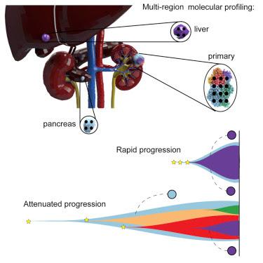 #Cell #carcinomerénal #métatstases Le suivi de l’évolution du cancer révèle les voies restreintes des métastases : TRACERx Renal