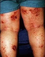 obat herpes di kaki Obat Herpes Di Kaki
