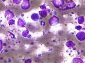 #thelancethaematology #lymphomediffus #gemcitabine #oxaliplatine #rituximab Gemcitabine oxaliplatine plus rituximab (R-GemOx) comme traitement première ligne chez patients âgés atteints lymphome diffus grandes cellules essai ouvert de...