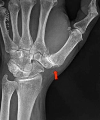 Rhizarthrose : Arthrose de la base du pouce Rhizarthrose : Arthrose de la base du pouce