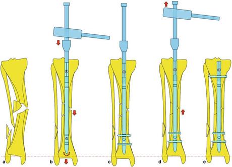Principes de l’enclouage centromédullaire des os longs