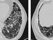 #thelancetrespiratorymedicine #fibrosepulmonaireidiopathique #biomarqueurs #pirfenidone Pronostics biomarqueurs prédictifs chez patients atteints fibrose pulmonaire idiopathique traités avec pirfenidone évaluation posteriori essais...