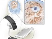 PARKINSON stimulation cérébrale profonde mais toute autonomie