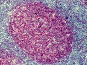 #thelancethaematology #lymphomefolliculaire #rituximab Rituximab risque transformation lymphome folliculaire analyse rétrospective données mutualisées