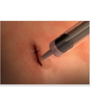 PLAIE CHIRURGICALE : Un alternative aux sutures, extensible et étanche