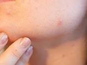Comment prévenir l'acné avoir peau saine