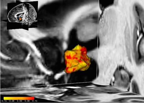 Chez ces patientes dépressives, les zones de l'hypothalamus (en rouge sur visuel) sont plus développées que chez leurs homologues en bonne santé.