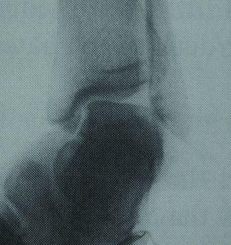 Instabilité chronique latérale de cheville après une entorse