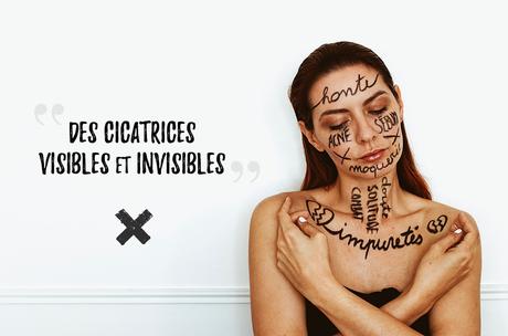 Acné Inside Out : la gamme Cleanance d’Avène Acné Inside Out : la gamme Cleanance d’Avène