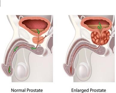 INCONTINENCE MASCULINE : Quand la prostate s'en mêle