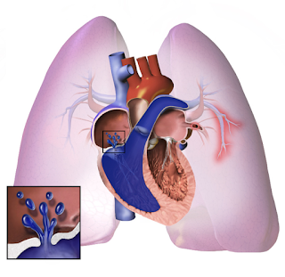 #thelancetrespiratorymedicine #HyperTensionPulmonaireThromboEmoliqueChronique #Treprostinil Treprostinil par voie sous-cutanée pour le traitement de l’HyperTension Pulmonaire Thrombo – Embolique Chronique (CTREPH) : essai de phase 3 en double-aveugle, ...