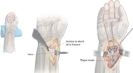 Fracture du poignet Pouteau-Colles