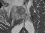 #thelancetoncology #lymphomeprimitif #SNC #rituximab Rituximab chez patients atteints lymphome primitif (HOVON 105/ALLG étude intergroupe phase randomisée ouverte