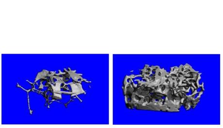 OSTÉOPOROSE : Et si le cerveau contrôlait aussi la densité osseuse ?