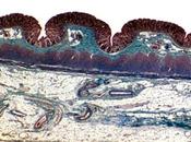 Pourquoi COLITE mène CANCER COLORECTAL