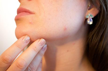 Marre de vos cicatrices d’acné?