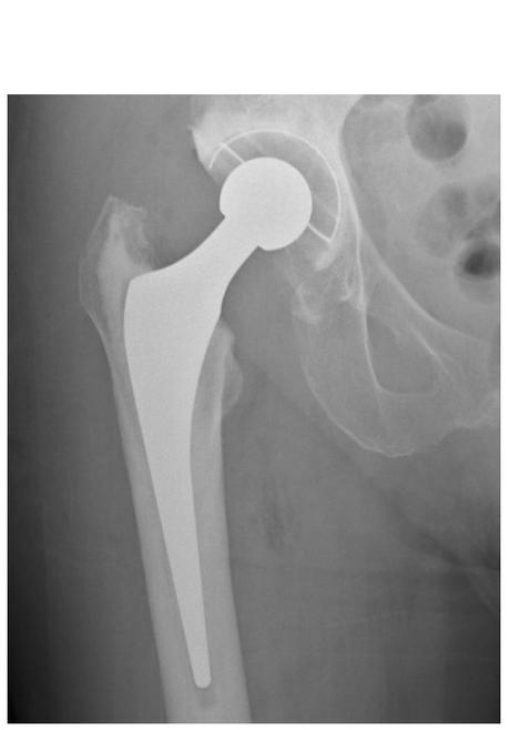 ARTHROPLASTIE de la HANCHE et du GENOU : Un taux de réussite élevé, un résultat durable