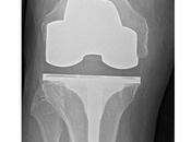 ARTHROPLASTIE HANCHE GENOU taux réussite élevé, résultat durable