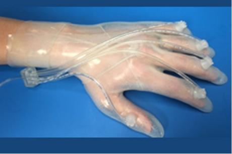 PLAIES de la MAIN : Le gant cicatrisant à pression négative