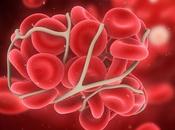 THROMBOSE échographie avancée pour détecter dissoudre