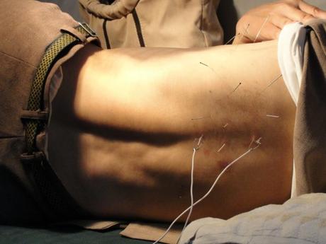 Acupuncture : une médecine pour se soigner naturellement et sans médicaments Acupuncture : une médecine pour se soigner naturellement et sans médicaments