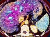 #thelancetdiabetesandendocrinology #diabètedetype2 #inversion Compréhension mécanismes d’inversion diabète type