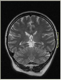 #thelancetoncology #gliomepédiatrique #selumetinib Administration de selumetinib chez des patients pédiatriques atteints de gliome de bas grade récidivant, réfractaire ou progressif associé à un gène BRAF aberrant ou une neurofibromatose de type 1 : es...