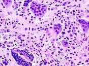 #thelancet #exclusif #tumeursynoviale #pexidartinib Pexidartinib versus placebo pour traitement d’une tumeur ténosynoviale avancée cellules géantes (ENLIVEN) essai randomisé phase