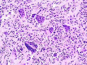 #thelancet #exclusif #tumeursynoviale #pexidartinib Pexidartinib versus placebo pour le traitement d’une tumeur ténosynoviale avancée des cellules géantes (ENLIVEN) : essai randomisé de phase 3