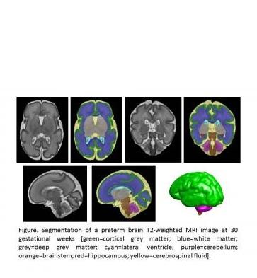 IRM cérébrale d’un bébé prématuré à 30 semaines de grossesse. Le vert représente la matière grise corticale, le bleu la substance blanche, le gris la matière grise profonde, le violet le cervelet, le rouge l’hippocampe