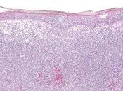 #thelancetoncology #exclusif #lymphomecutanéàcellulesT #IPH4102 IPH4102, nouvelle classe d’anticorps monoclonal anti-KIR3DL2, chez patients atteints lymphome cutané cellules récidivant réfractaire étude internationale phase ouve...