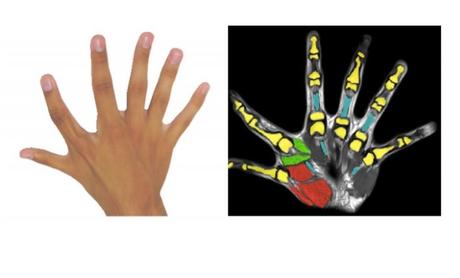La polydactylie, ou 6 doigts par main, c’est aussi la présence de muscles supplémentaires et des capacités de manipulation augmentées