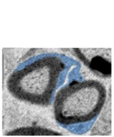 SEP, troubles du SNC : La capacité prolifique des cellules de Schwann à générer la myéline