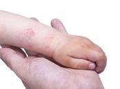 ECZÉMA Tremper hydrater