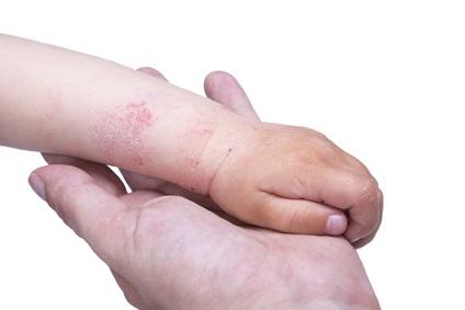 Les crevasses cutanées liées à l’eczéma favorisent les maladies allergiques de tous types.