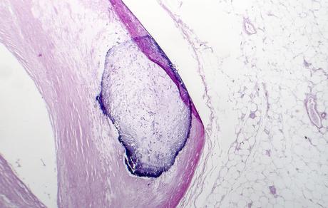 De minuscules particules ressemblant à de l’os sont retrouvées dans la circulation sanguine périphérique