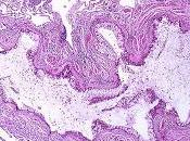 #thelancet #asthme #trithérapie #Inhalateurunique trithérapie particules extrafines administrée inhalateur unique dans traitement l’asthme contrôlé (TRIMARAN TRIGGER) deux essais phase double-aveugle, groupes parallèles,