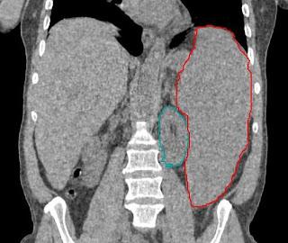 #thelancethaematology #leucémiemyéloïde #treosulfan #busulfan #fludarabine [Treosulfan ou Busulfan] plus Fludarabine comme traitement de préparation à une transplantation allogénique de cellules souches hématopoïétiques chez des patients atteints de le...