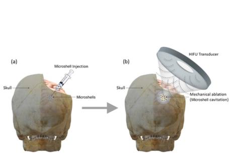 En modulant les ultrasons à haute fréquence, les chercheurs sont capables de créer différentes températures sous lesquelles les cellules cancéreuses se rompent. En modulant les ultrasons à haute fréquence, les chercheurs sont capables de créer différentes températures sous lesquelles les cellules cancéreuses se rompent.