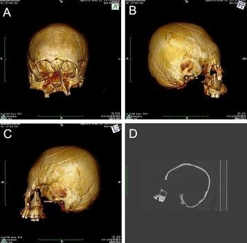 D'anciens squelettes au crâne déformé mis au jour en Croatie