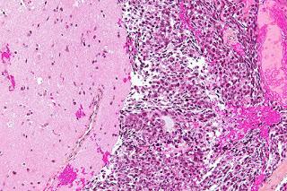 #thelancetoncology #CBNPC #lorlatinib #crizotinib Lorlatinib dans les cancers du poumon non à petites cellules avancé ROS1-positif : essai de phase 1-2 à simple bras, multicentrique, ouvert