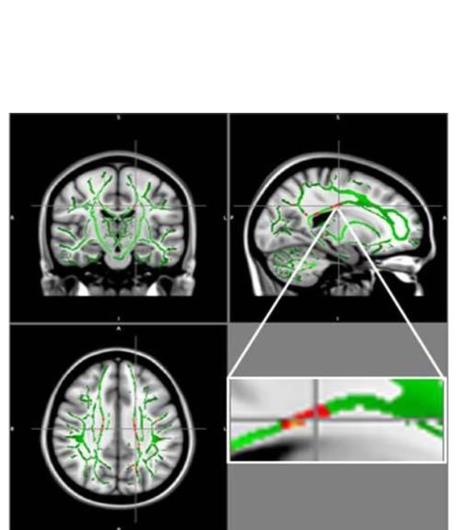 Ces réductions de FA sont identifiées principalement dans le corps calleux, un faisceau de fibres nerveuses qui relie les hémisphères gauche et droit du cerveau, dans le gyrus orbitofrontal moyen, une région du cerveau impliquée dans le contrôle des émotions et dans le circuit de récompense. 