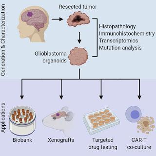 #Cell #organoïde #glioblastome #biobanque Un Modèle Organoïde de Glioblastome et de Biobanque Provenant d’un Patient Résume l’Hétérogénéité Tumorale